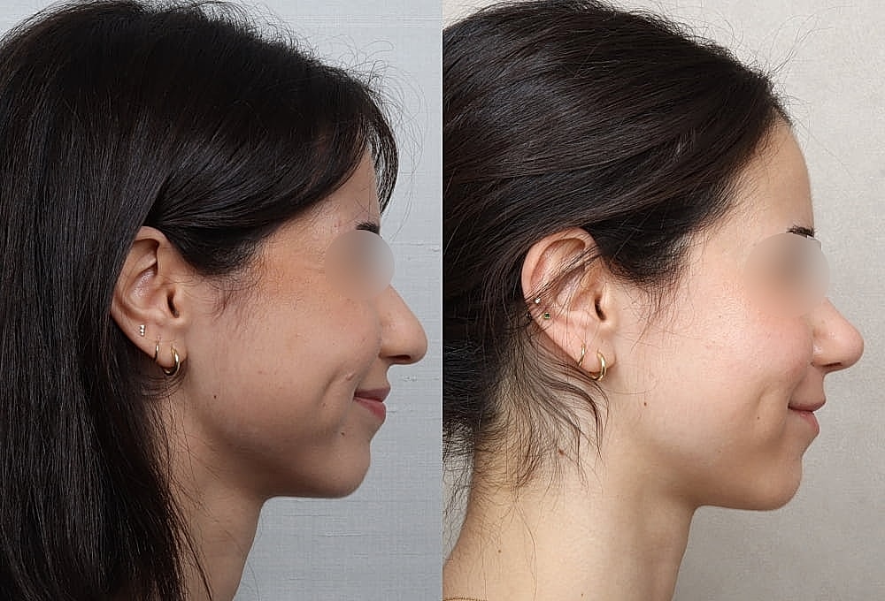 Before and after profile view of a woman.
