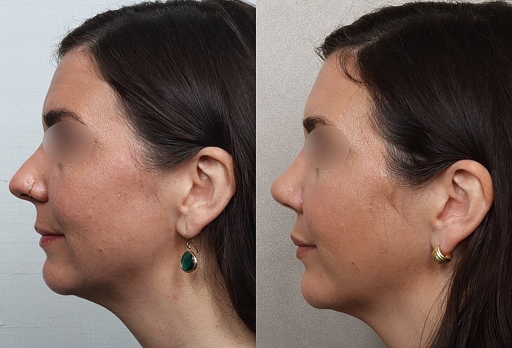 Profile comparison before and after treatment