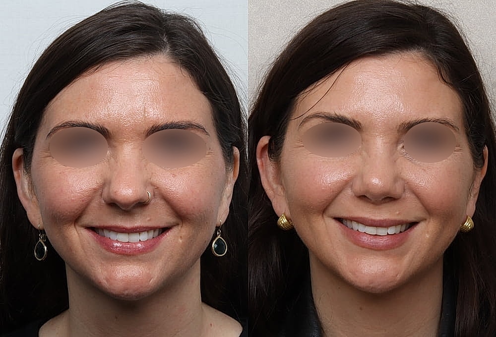 Before and after facial aesthetic treatment comparison.
