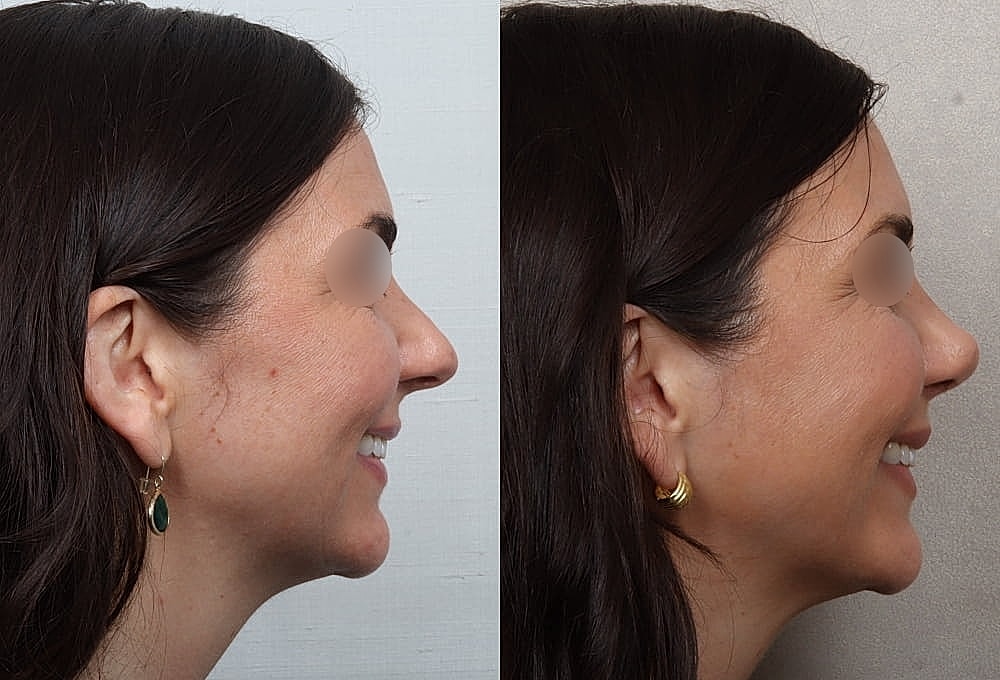 Before and after profile comparison of a woman.