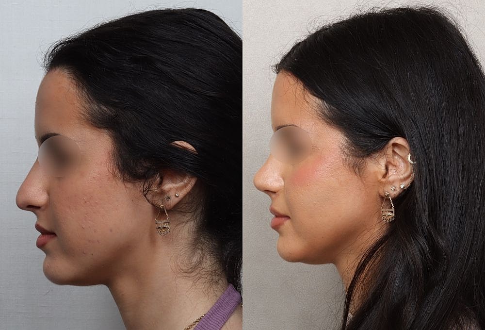 Profile comparison of a woman's facial features.