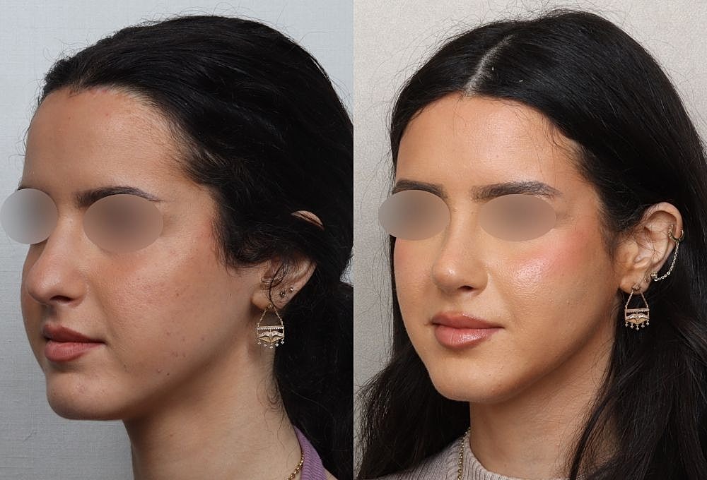 Before and after photo showcasing facial profile changes.