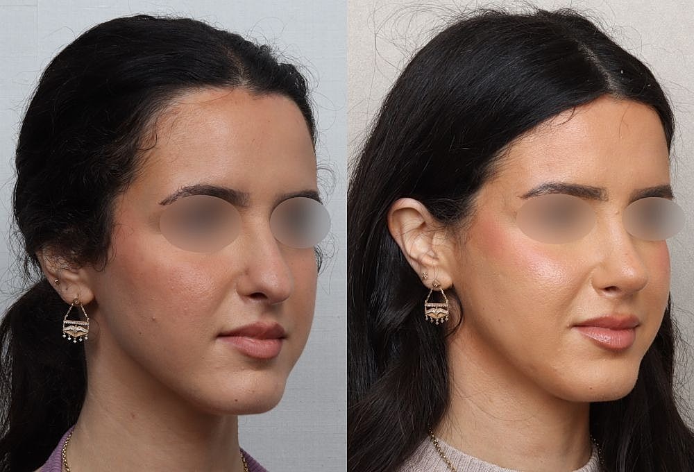 Before and after facial appearance comparison.