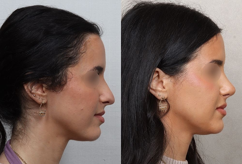 Profile comparison before and after aesthetic treatment