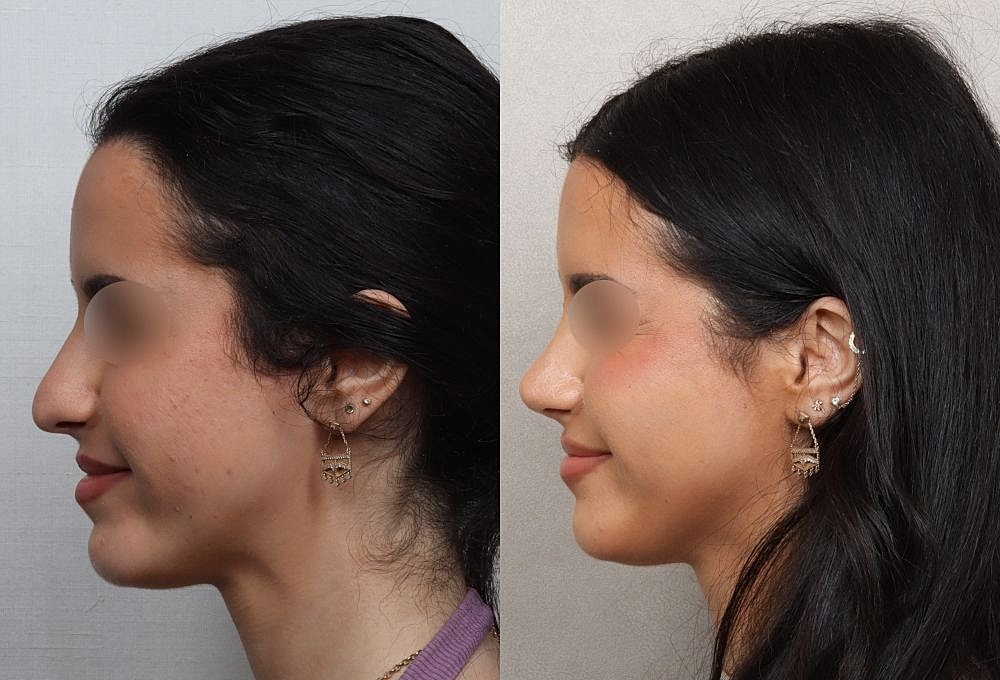Before and after profile view of woman.