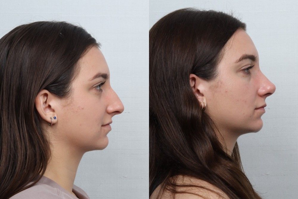 Rhinoplasty Before & After