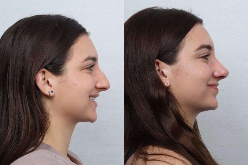 Rhinoplasty Before & After