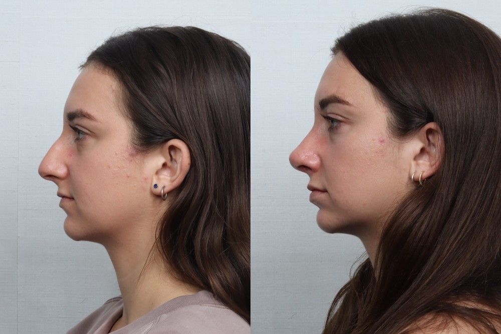 Rhinoplasty Before & After