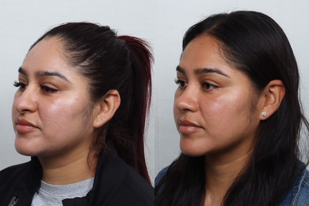 Rhinoplasty Before & After