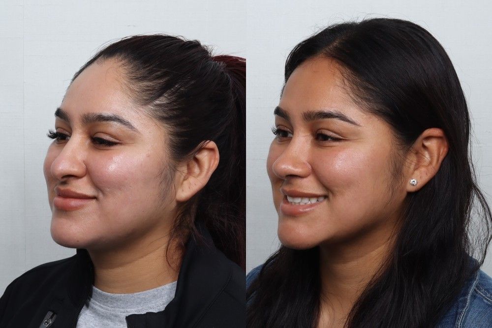 Rhinoplasty Before & After