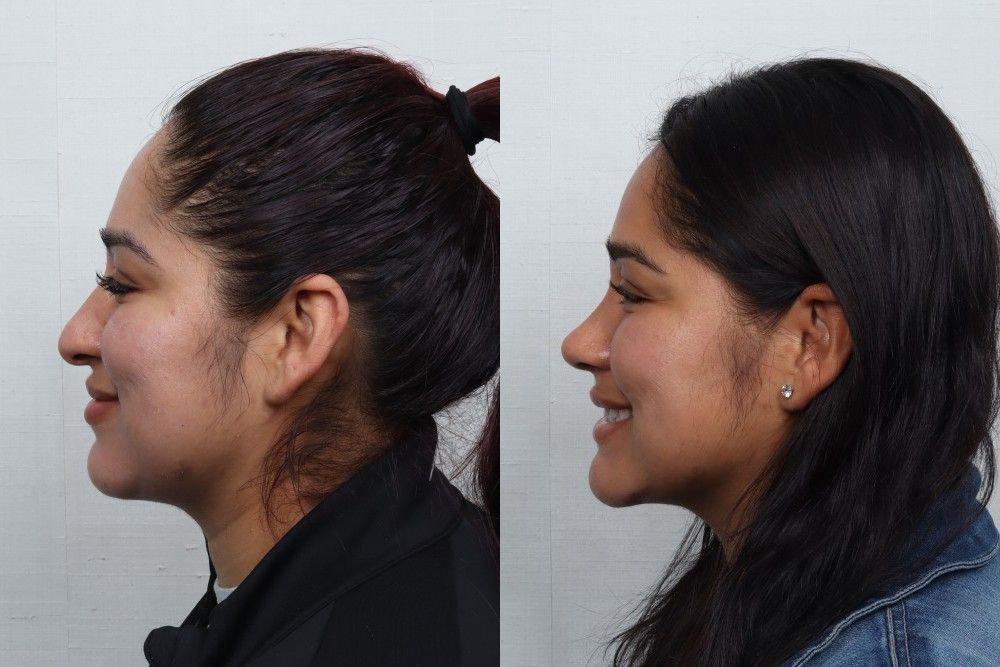 Rhinoplasty Before & After