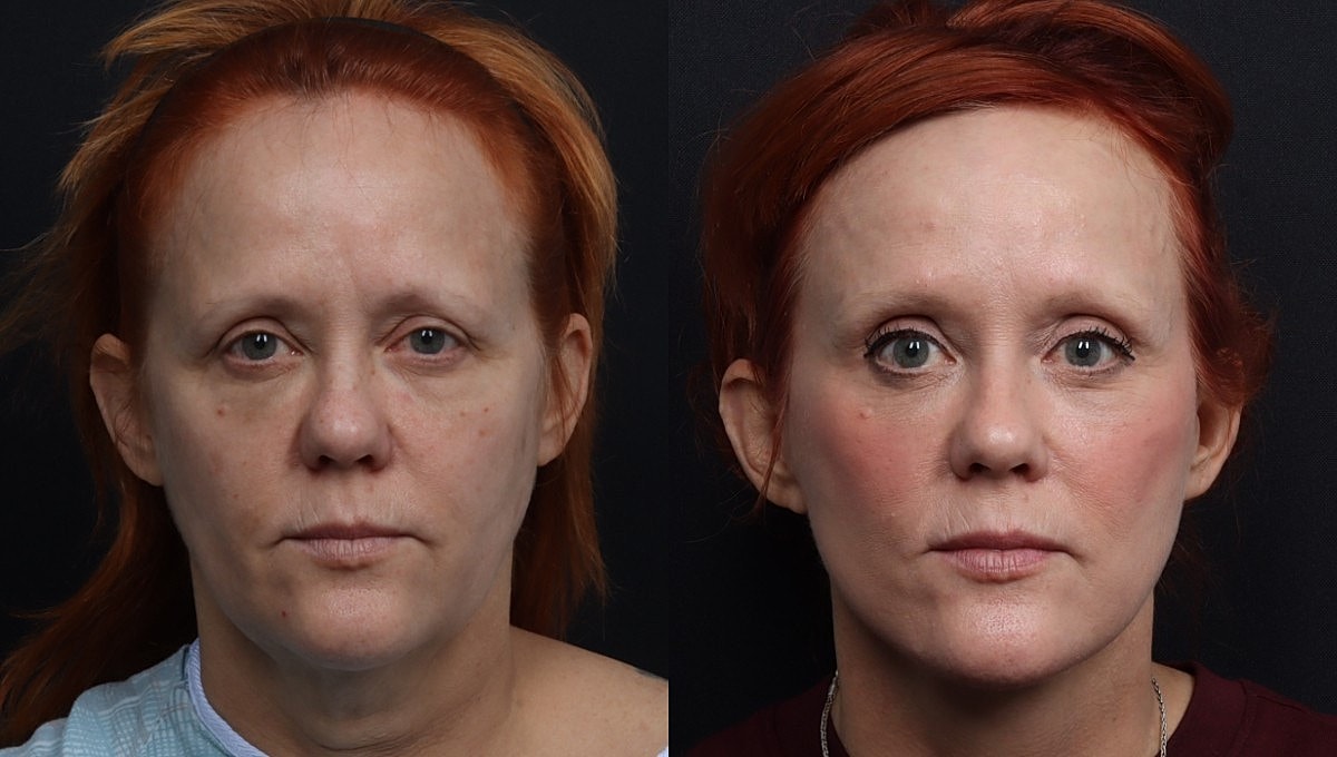 Facelift Before & After