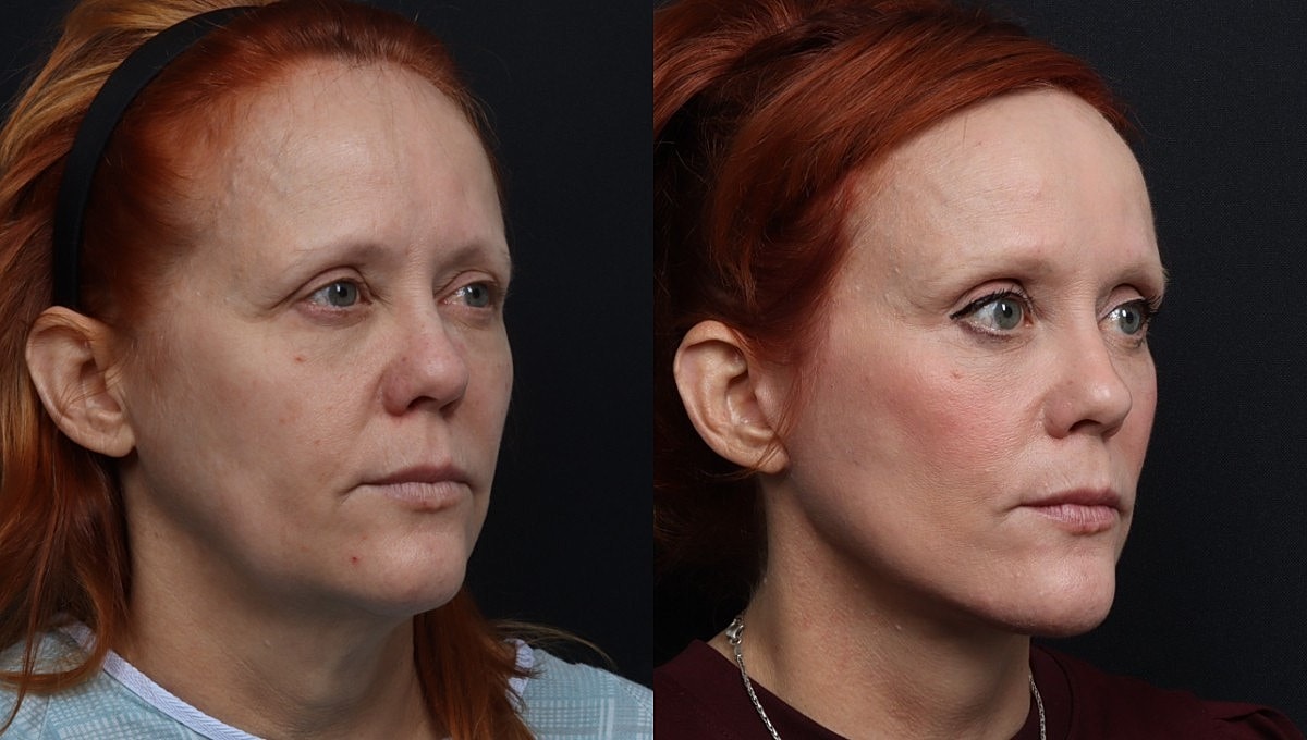 Facelift Before & After