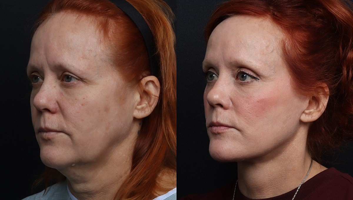 Facelift Before & After