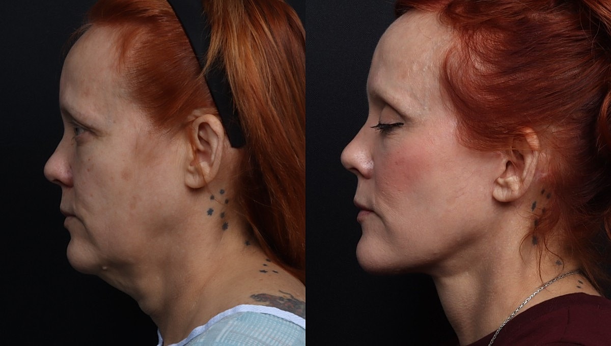 Facelift Before & After