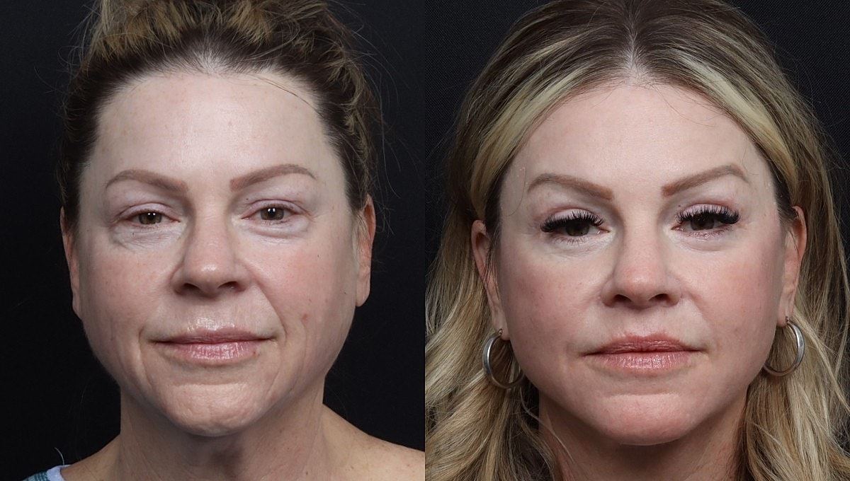 Facelift Before & After