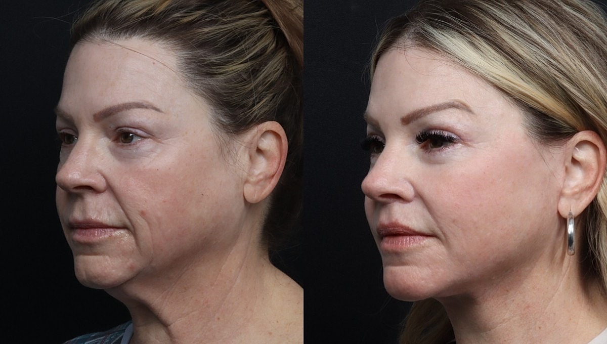 Facelift Before & After