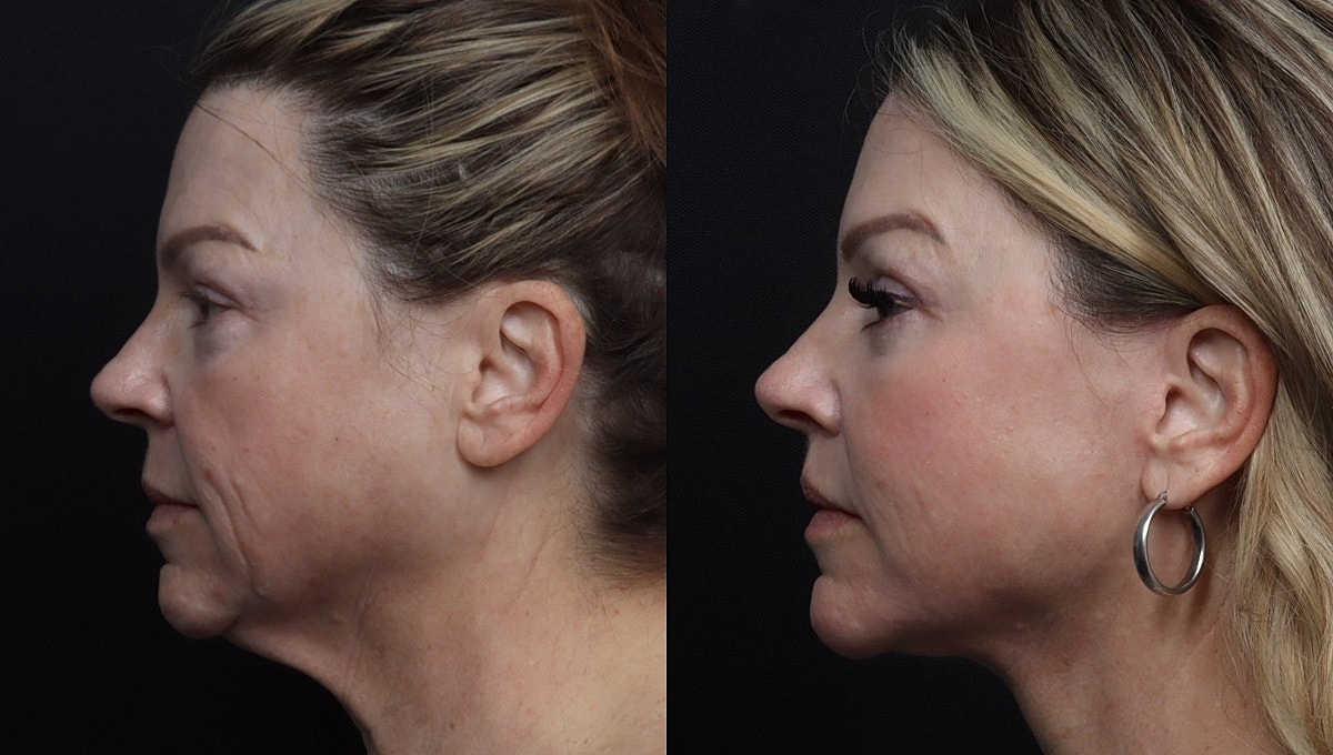Facelift Before & After