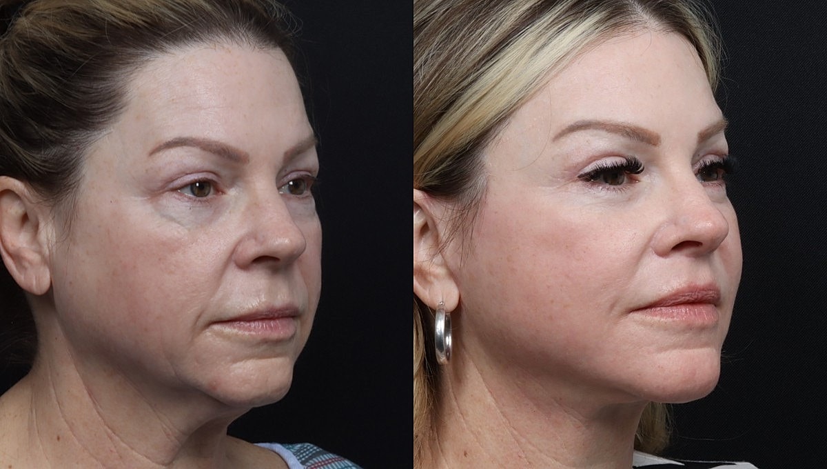 Facelift Before & After