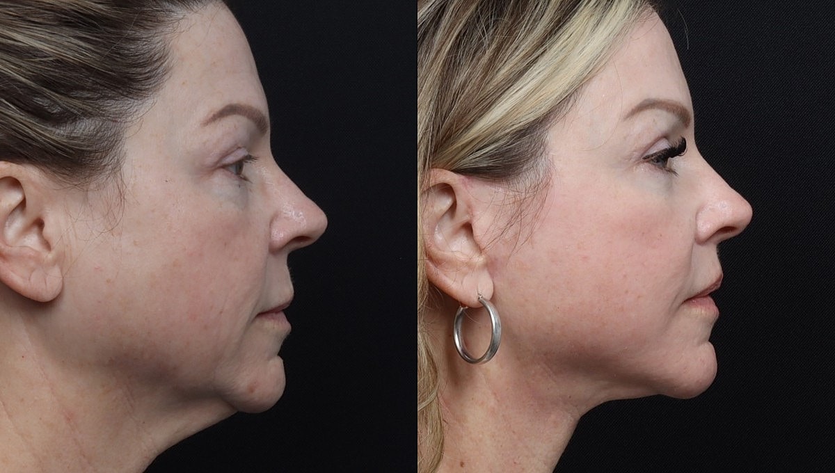 Facelift Before & After