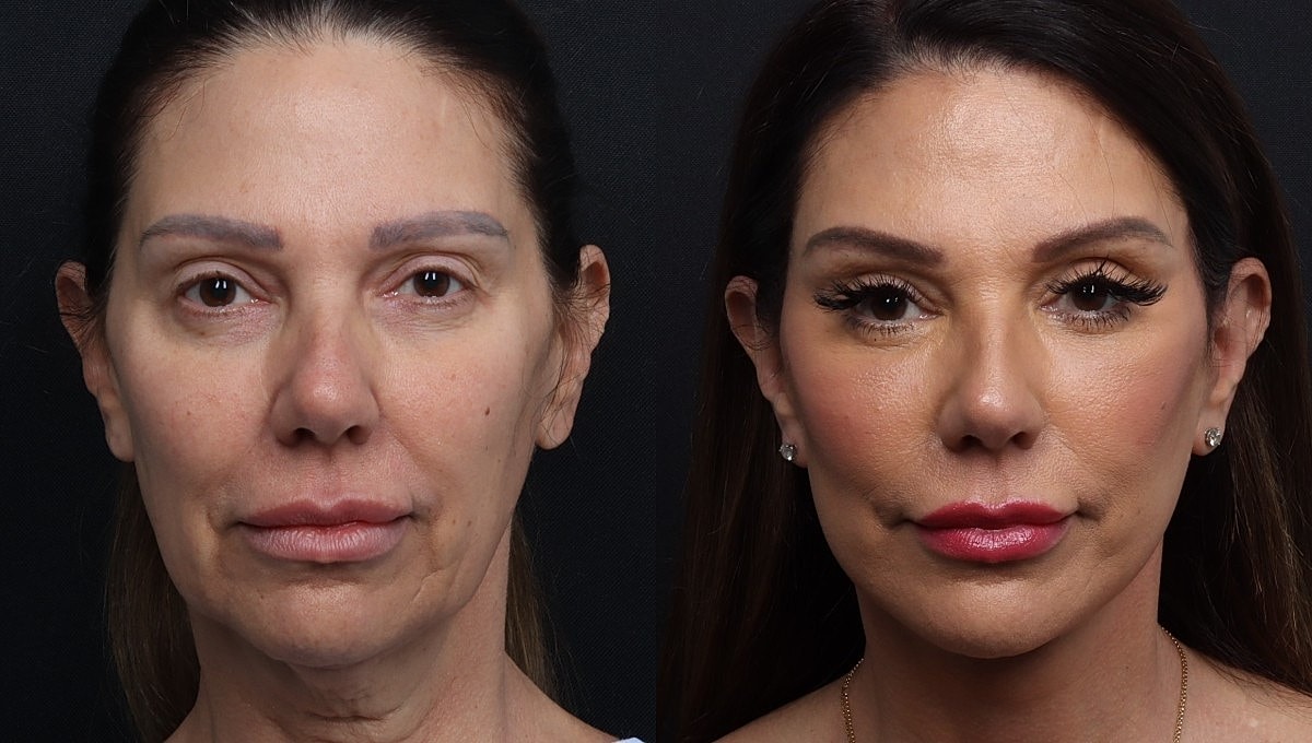 Facelift Before & After