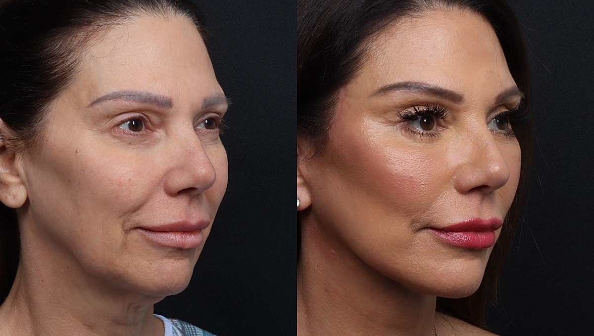 Facelift Before & After
