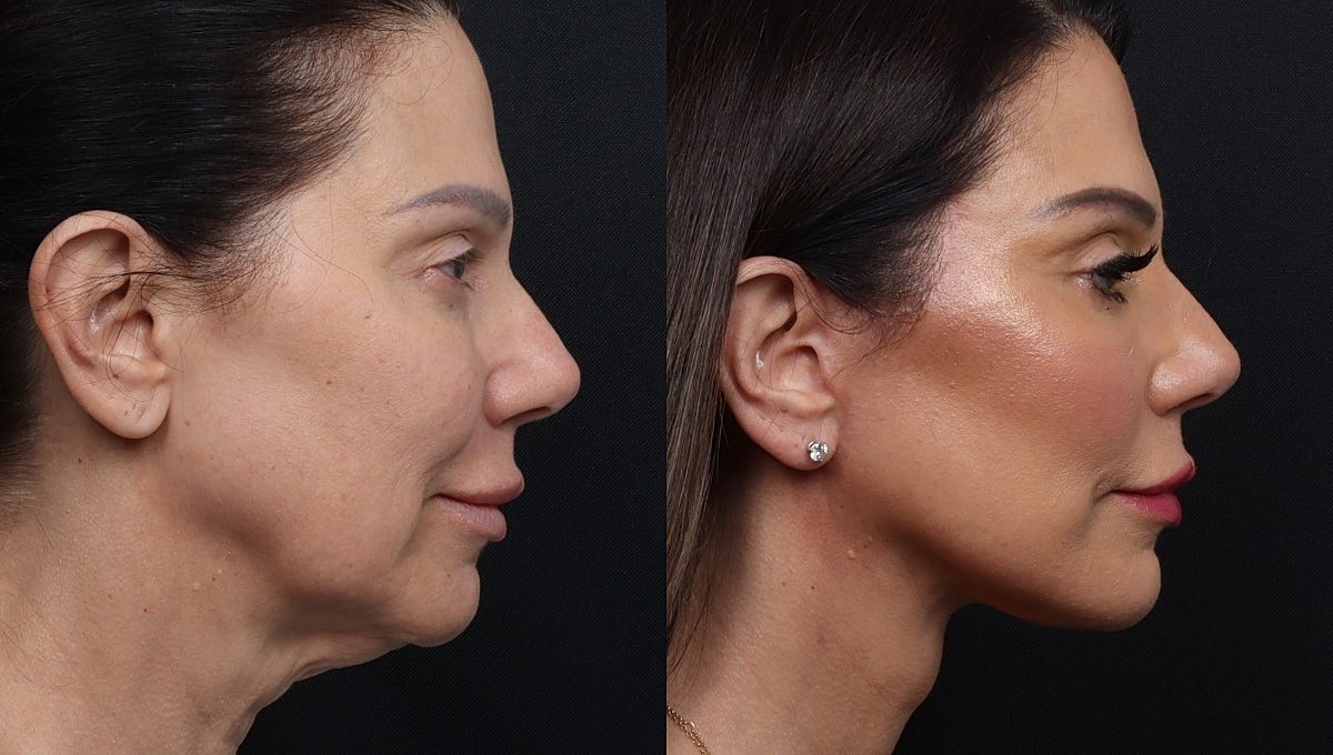 Facelift Before & After