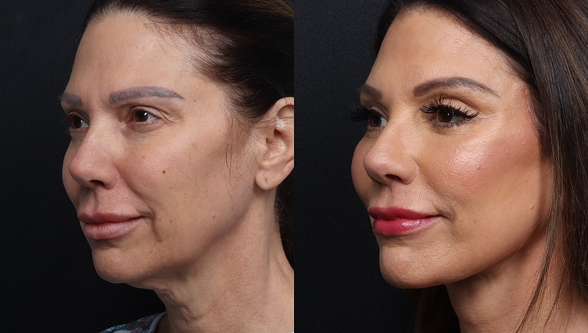 Facelift Before & After