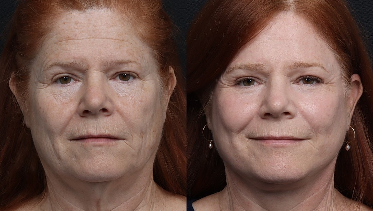 Facelift Before & After