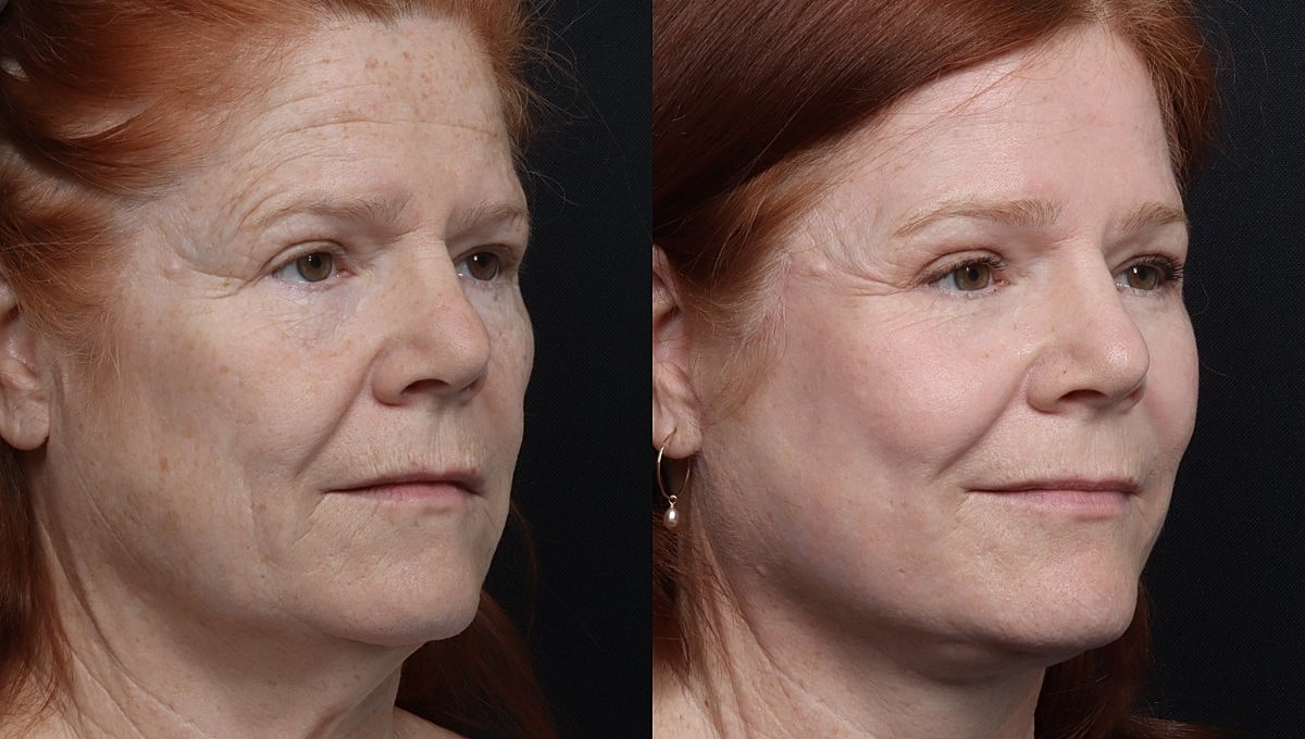 Facelift Before & After