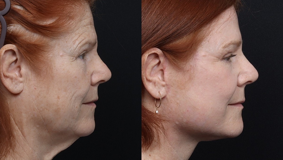 Facelift Before & After