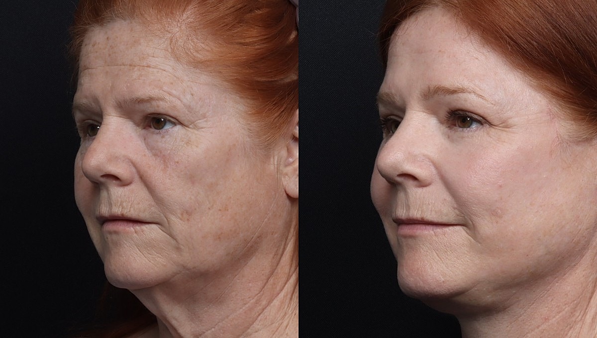 Facelift Before & After