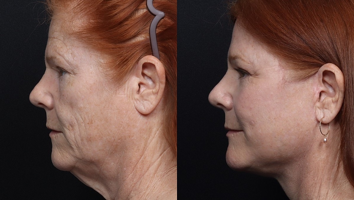 Facelift Before & After