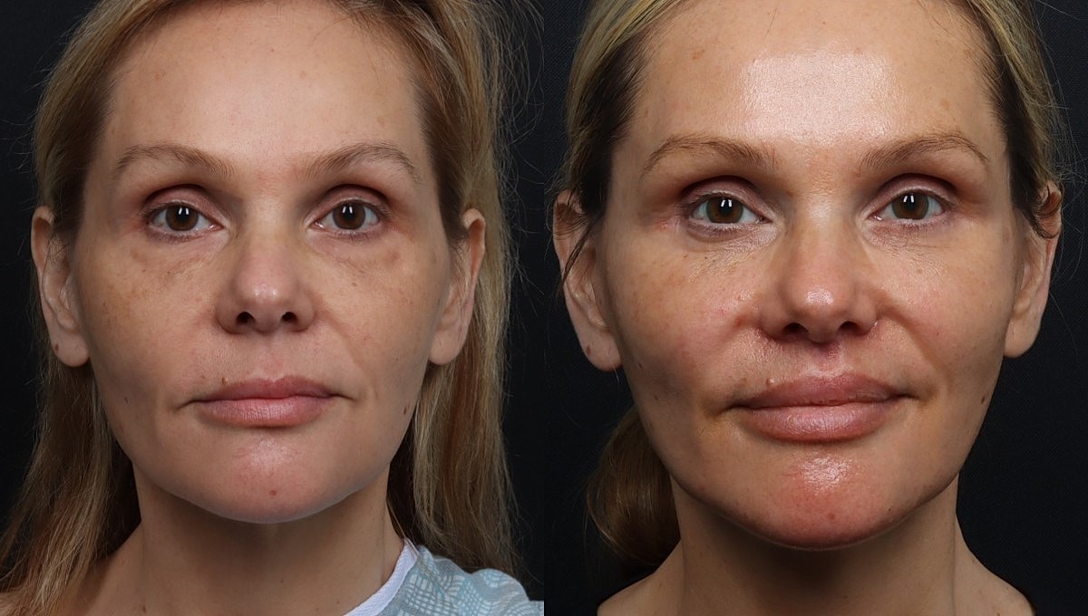 Facelift Before & After