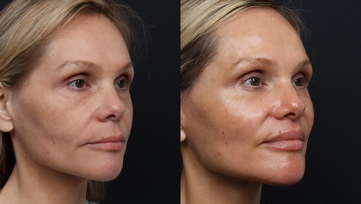 Facelift Before & After