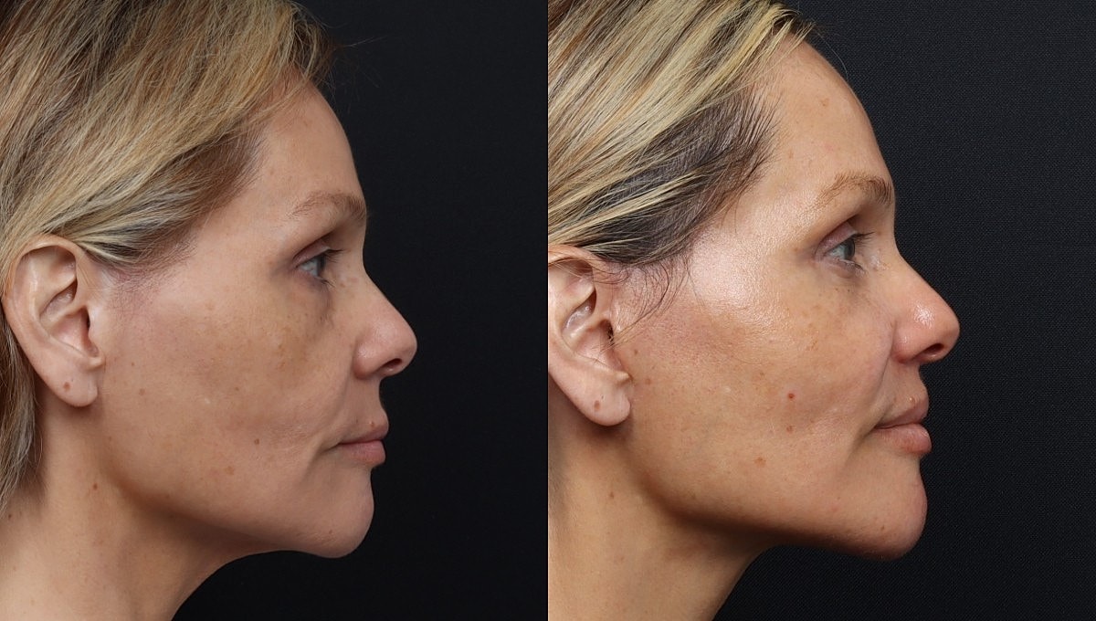 Facelift Before & After