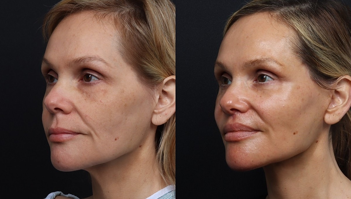 Facelift Before & After