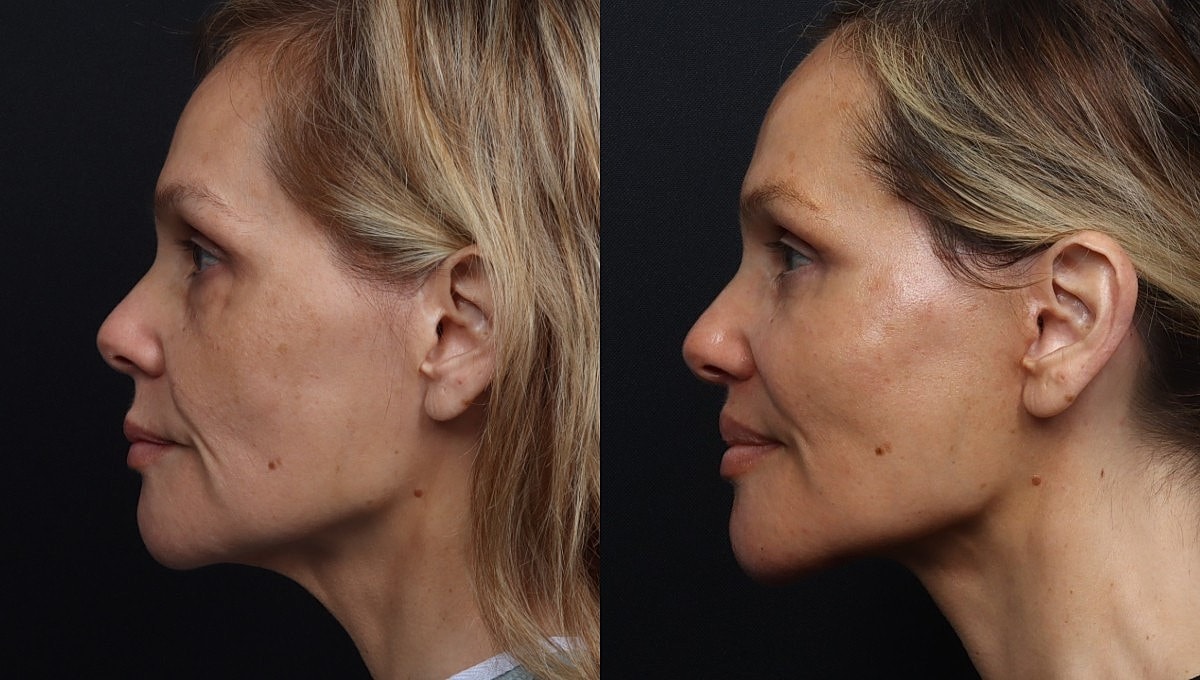 Facelift Before & After