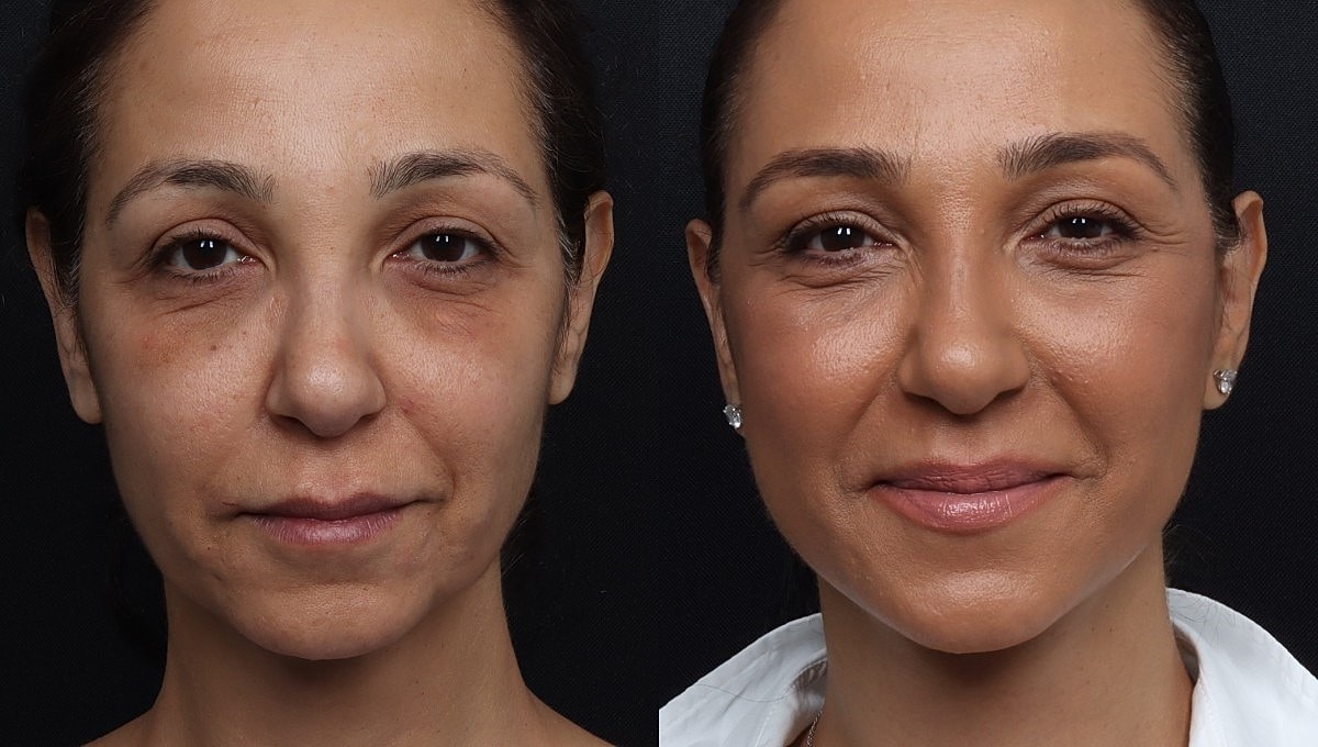 Facelift Before & After