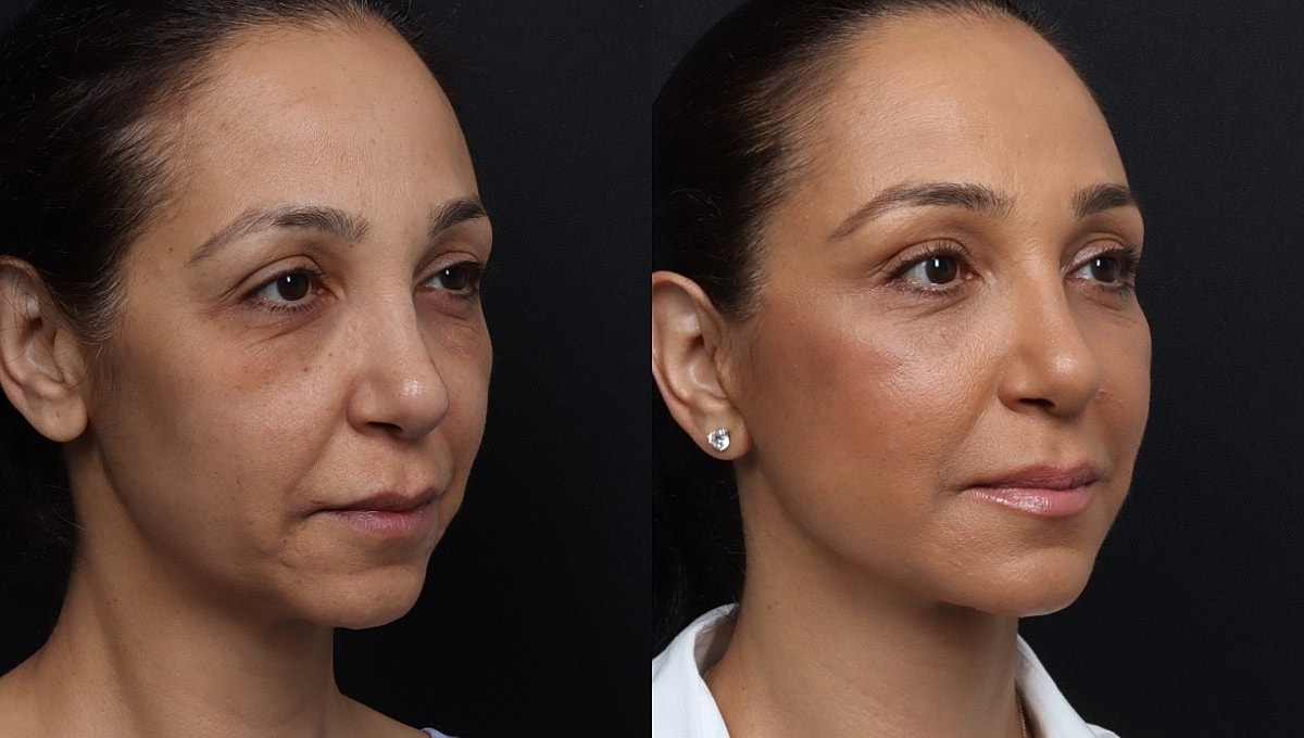Facelift Before & After