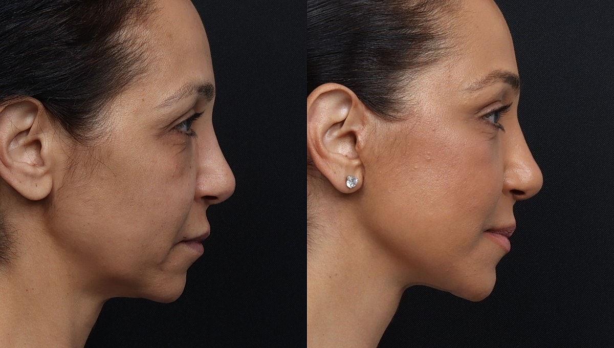 Facelift Before & After