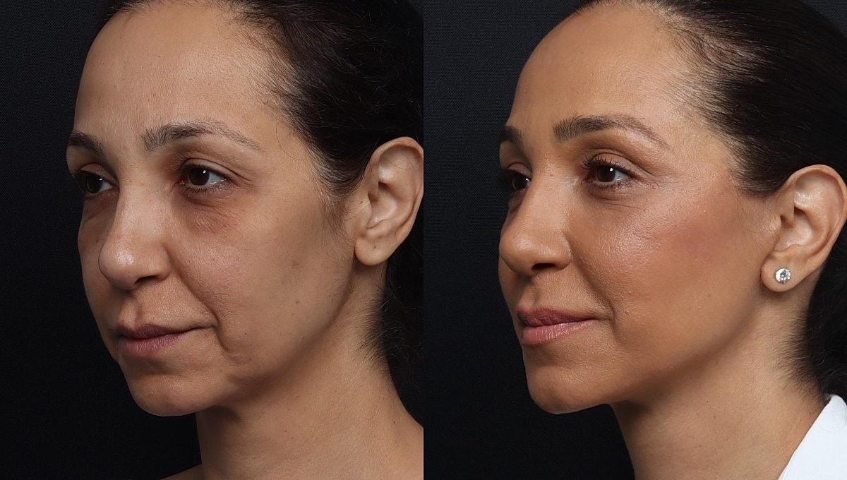 Facelift Before & After