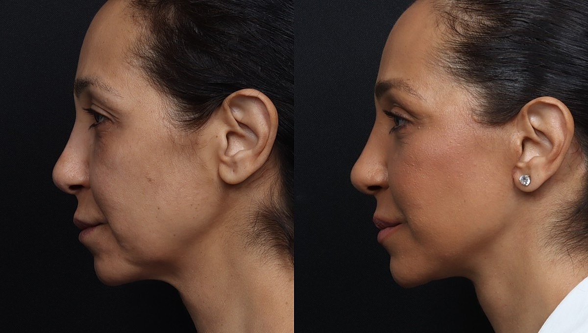 Facelift Before & After