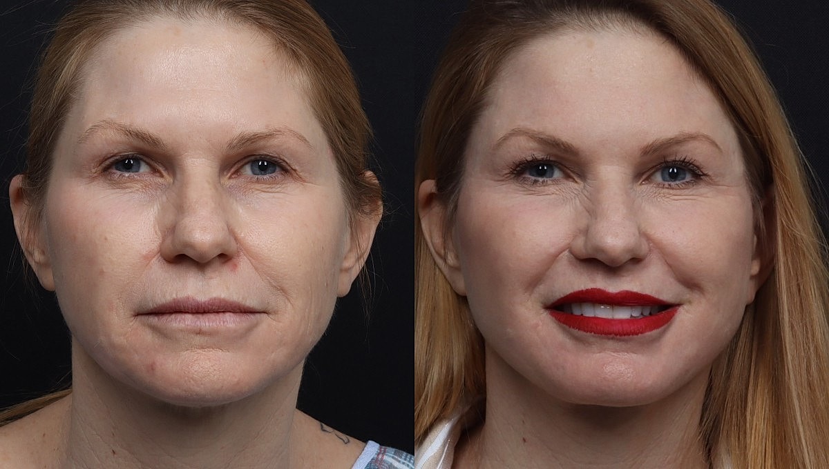 Facelift Before & After