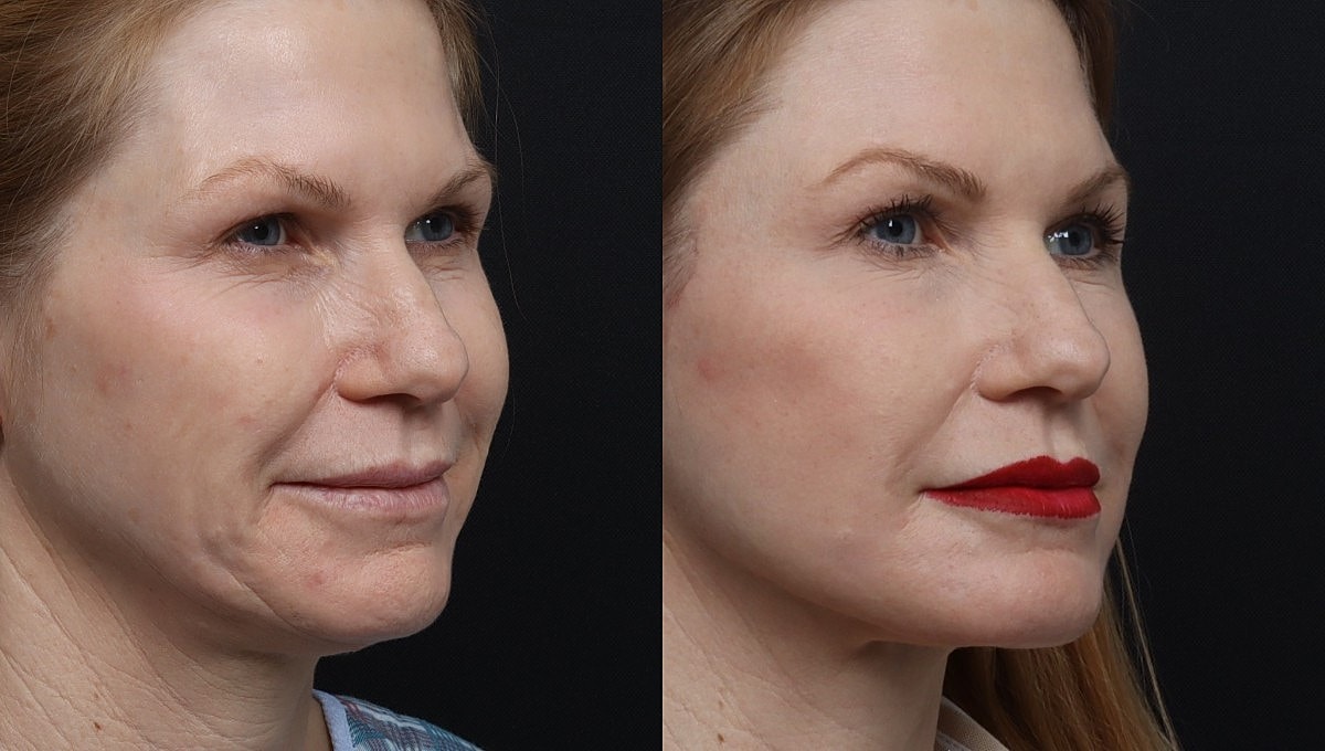 Facelift Before & After