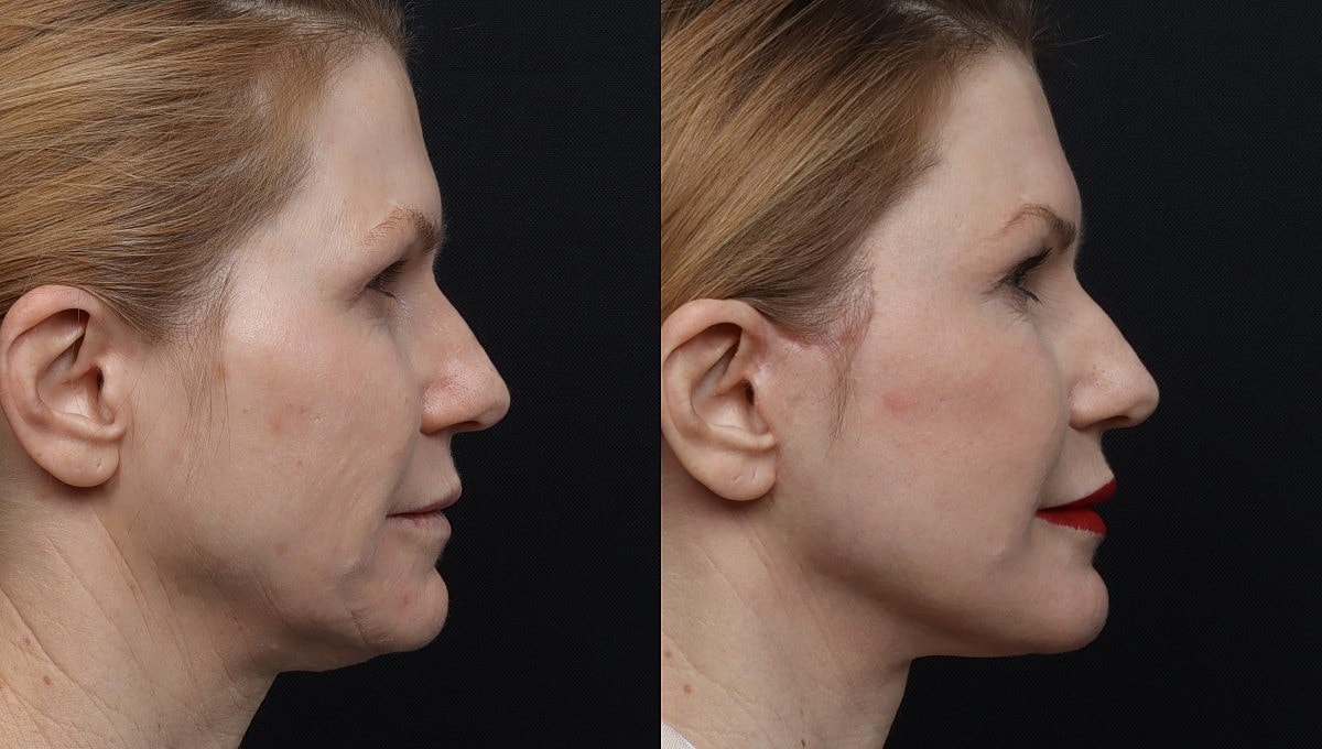 Facelift Before & After