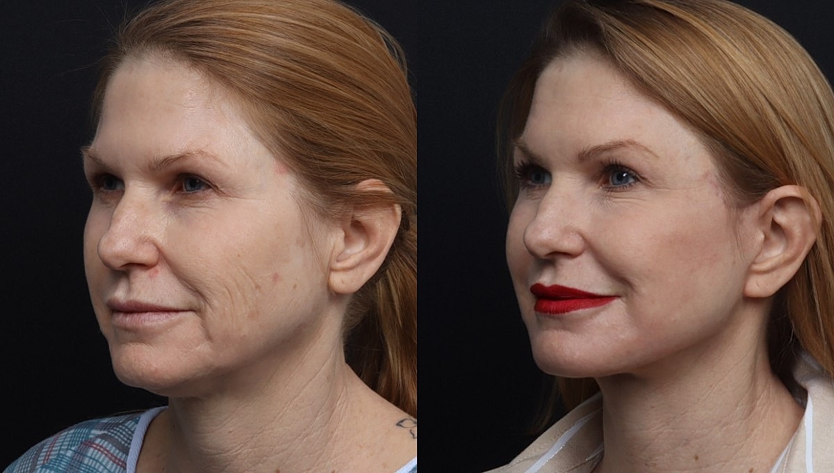 Facelift Before & After