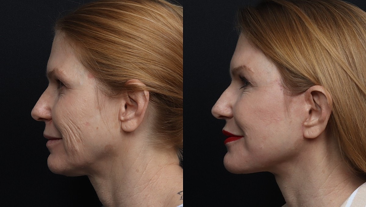 Facelift Before & After