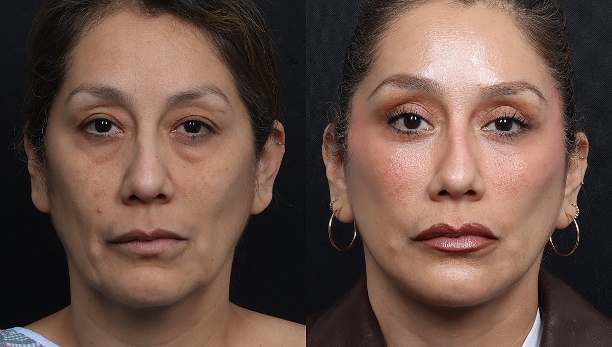 Facelift Before & After