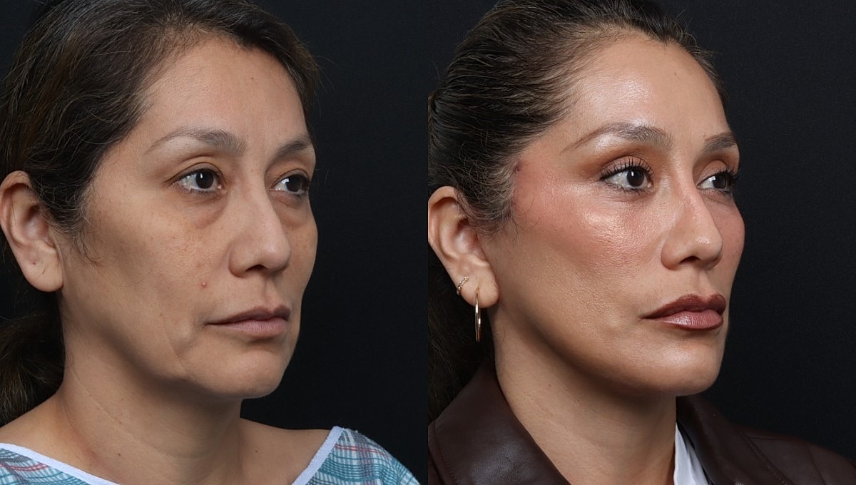 Facelift Before & After